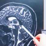 traumatic brain injury attorneys