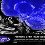 Traumatic Brain Injury Attorneys