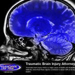 Traumatic Brain Injury Attorneys