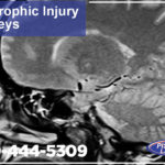 Exploring Famous Catastrophic Injury Cases