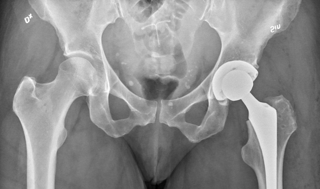 Common Complaints Resulting From Defective Hip Implants