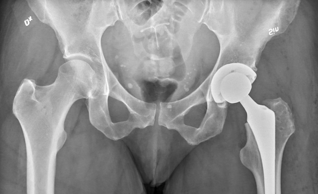 common-complaints-resulting-from-defective-hip-implants-pisanchyn-law